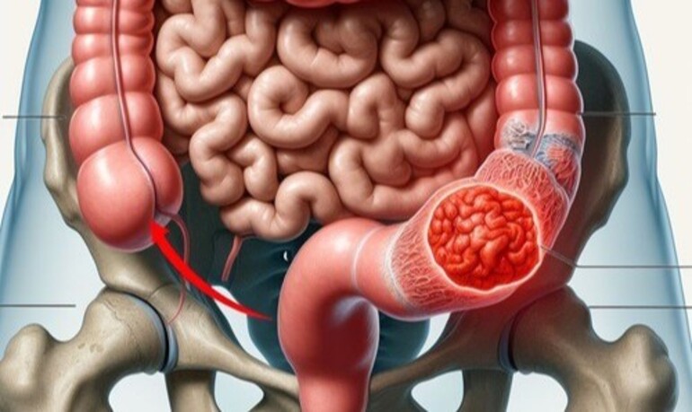 Intestinal Obstruction Surgery